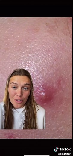 Dealing with Cysts: Expert Tips and Tricks