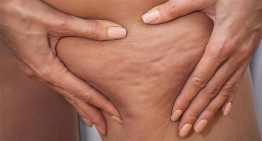 How to get rid of cellulite