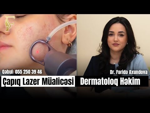 ÇAPIQ MÜALİCƏSİNDƏ DƏQİQ NƏTİCƏ \ DERMATOLOQ