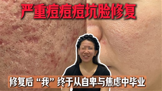 红肿严重痘痘痘坑修复，18岁女大从自卑和焦虑中毕业了！