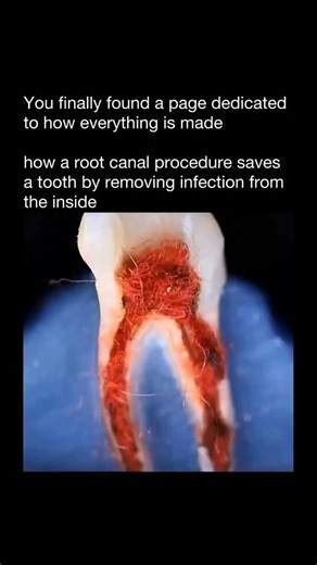 How Everything Is Made on Instagram: "how a root canal procedure saves a tooth by removing infection from the inside 🦷⚙️ A root canal begins when decay or injury allows bacteria to reach the pulp at the center of the tooth. The dentist creates a small opening, removes the infected pulp, and carefully cleans and shapes the inner canals using precision instruments. Once disinfected, the canals are filled with a biocompatible material and sealed to prevent reinfection. The tooth is then restored, 