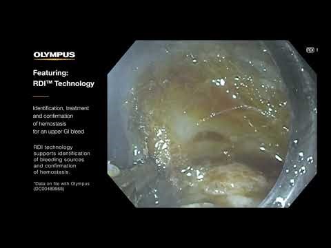 Identify Bleeding Points with RDI™ Technology