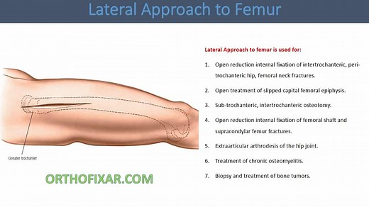Lateral Approach To Femur • Full & Easy • OrthoFixar 2026