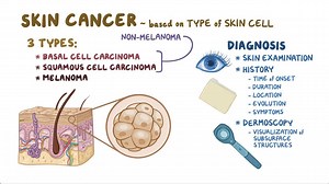 Video: Skin cancer: Clinical - Video Explanation! | Osmosis | Osmosis