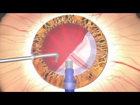 Cataract surgery Phacoemulsification and intraocular lens implantation