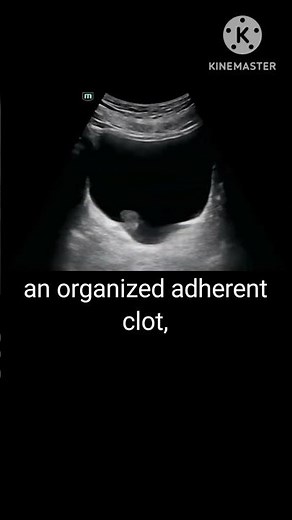 Urinary bladder mass on ultrasound #ultrasound