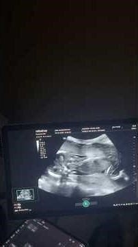 Ultrasound day, we could already see the baby's gender 🥰. #maternity #pregnancy #ultrasound #preg...