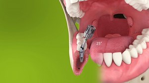 Straumann Angled Solutions: Flexibility and precision from a...