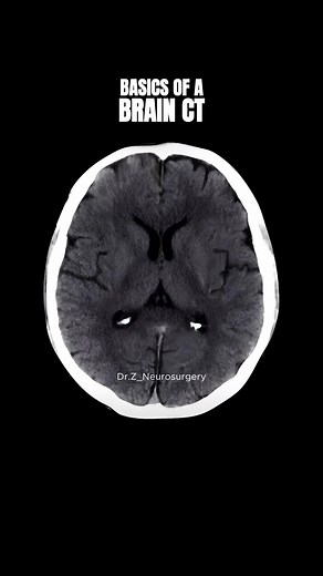 How to read a brain CT scan. #Medicine #Doctor #Radiology #Brain #Neuro