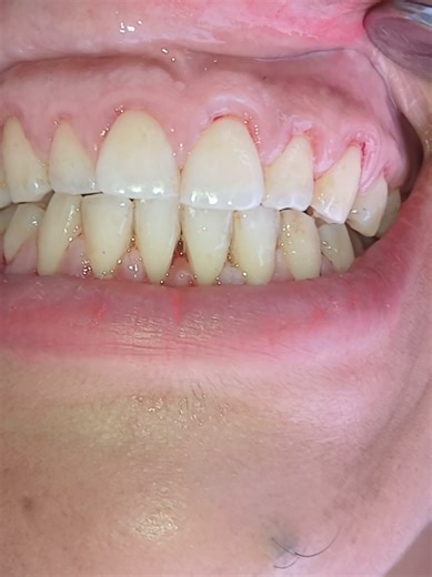 Professional Tooth Cleaning for a Healthy Smile