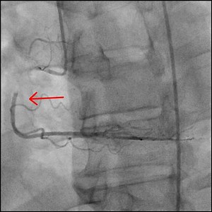 Air Embolism - Case 2 - Cardiology Apps