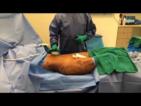 Dr. DuPéré LIVE Surgery: Hip Augmentation, Liposuction, Fat Grafting