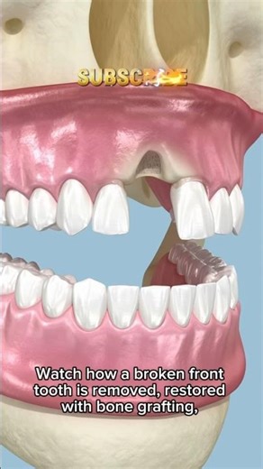 Tooth Implant in 3D | Dental Implant Animation #dentist #dentalcare #orthodontist #teethdecay