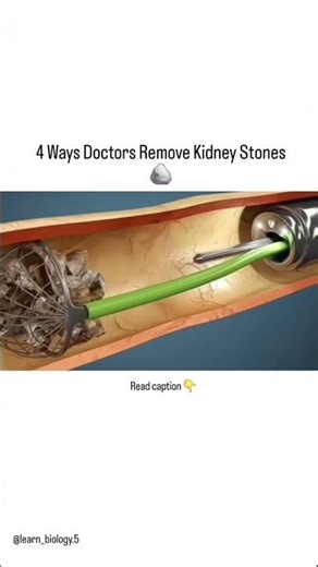 4 ways Doctor's Remove kidney stones