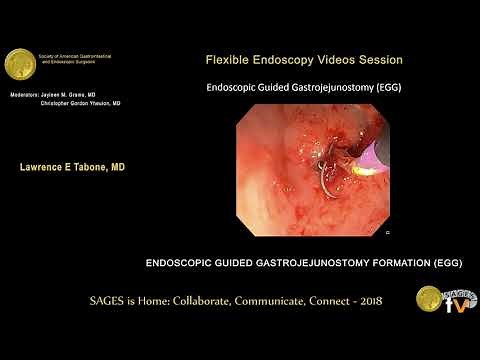 Endoscopic guided gastrojejunostomy formation (EGG)