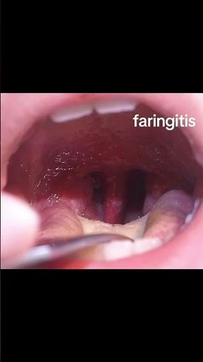 CAUSAS DE LA FARINGITIS 😷 #dentista #faringitis