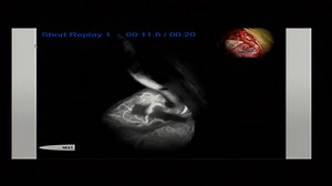 Dr. Michael Lawton: STA-MCA Bypass Surgery - About the Surgeon and Procedure - Live Neurosurgery and Chat with Dr. Lawton