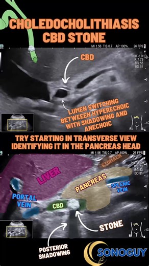 Identifying Choledocholithiasis in Ultrasound Imaging