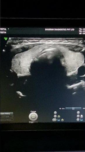 What Does a NORMAL Thyroid Ultrasound Look Like? #thyroid #thyroidproblems #drvandanaa