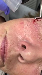 Profractional laser to festoons