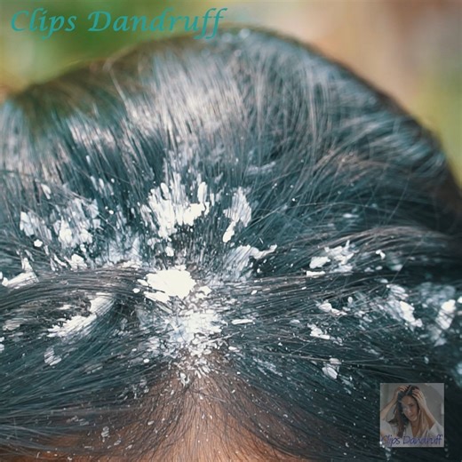 A Complete Guide to Scalp Care for Dandruff Solutions! 405 | Clips Dandruff