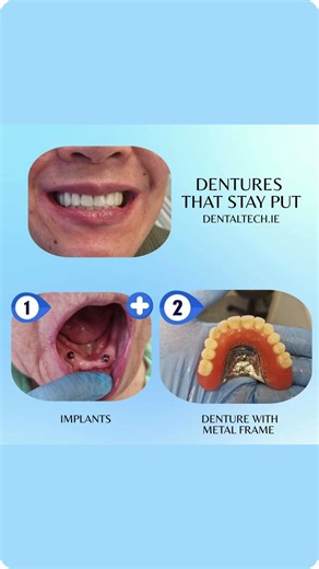 Dentures That Stay Put #shorts