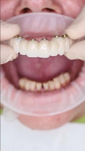 Implant Supported Denture #dentist #dentalprocedure