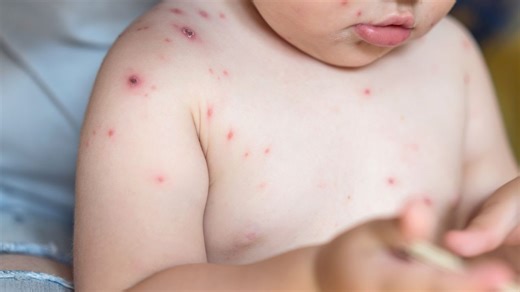 Premiers symptômes et formes des boutons... voici comment reconnaître la varicelle