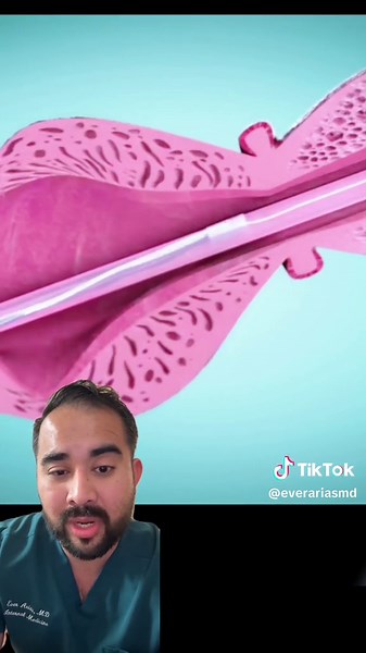 Urethral stricture dilation procedure #foleycatheter #hospital #nursing #nurse #medical #medicaltiktok #physician #doctorreacts #medicine #doctor #CapCut