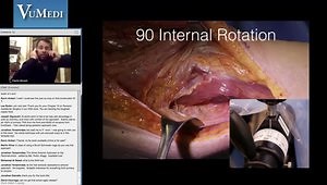 Anterior Approach Femoral Revision