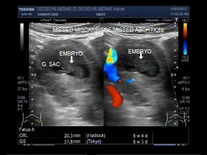 Early Missed miscarriage of about 8 weeks.