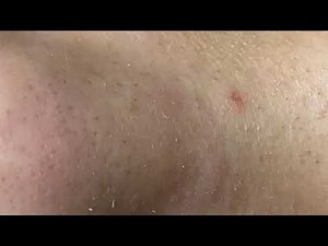 Pimples Under The Skin - SacDepSpa#167