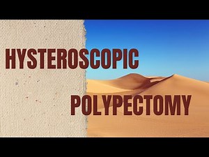 Hysteroscopic Polypectomy | Tips for Safe Removal