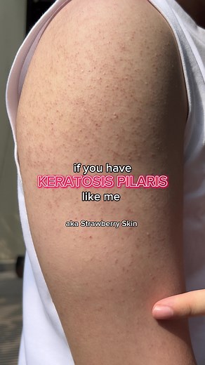 How to Improve Body Skin Texture: Tips for Keratosis Pilaris & Strawberry Skin