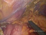 Laparoscopic Total Gastrectomy for the Recurrence in the Remnant Stomach after Open Partial Gastrectomy • Video • MEDtube.net