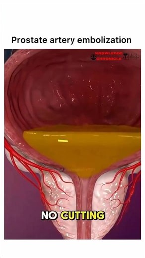 Prostate Artery Embolization: How Doctors Shrink an Enlarged Prostate Without Surgery #shorts #reels