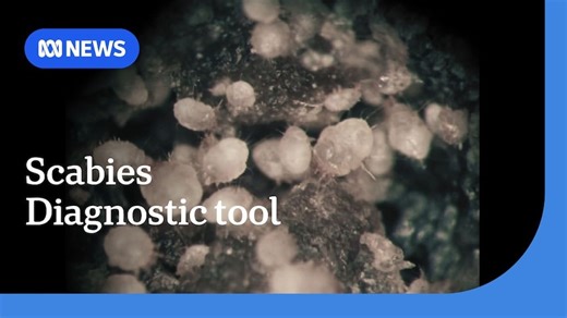 Researchers and biotech firm create scabies diagnostic tool