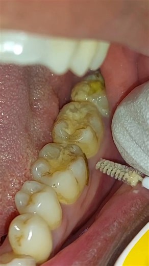 Nepalidentist on Instagram: "I highly recommend using proxabrush to clean gap between 2 teeth. Waterflosser in combination with proxabrush gives awsome result. #oralhygiene #proxabrush #publicawareness #nepalidentist #healthlifestyle"