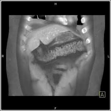 Abdomen: Liver: CT Angiography with 3D Mapping demonstrates an AVM in the liver