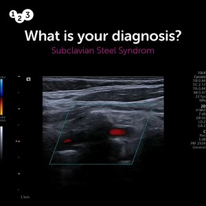 What are the features of subclavian steal syndrome on ultrasound? 🤔 A) Retrograde flow in an ipsilateral vertebral artery B) Presence of a highly echogenic and homogeneous plaque in the common carotid artery C) Increased peak systolic velocity in the internal carotid artery D) Exaggerated antegrade flow in the ipsilateral vertebral artery E) Turbulent flow in the ipsilateral vertebral artery Do you know the answer? Let us know what you think in the comments!💡 Only today, get 40% off the Caroti