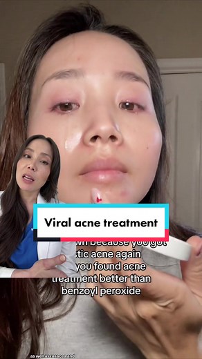 Effective Sulfur Acne Treatment: Benefits and Results