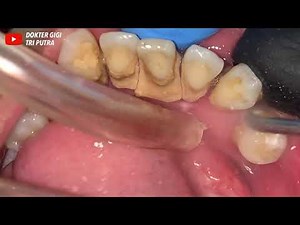 Ultimate Tartar Removal Secrets: Transform Your Smile in Minutes