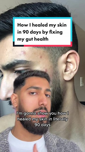 Heal Your Skin in 90 Days: Gut Health & Acne Solutions