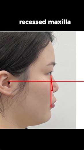 Get your psl scores with @PSL App #maxilla