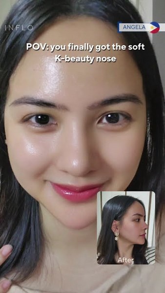 POV : you finally got the soft K-beauty nose #shorts #nosejobbeforeandafter #nosejobresults