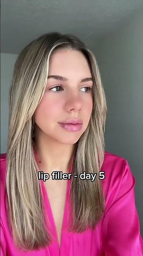 Lip Filler Results Over A Week 👄 Healing Process