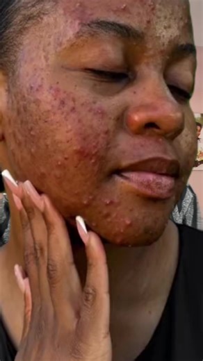 🔥 PURITO   345 Relief – Duo choc anti-imperfections ! Tu galères avec des boutons, des rougeurs, des cicatrices ? 🔹 PURITO : calme l’inflammation, répare la peau 🔹 345 Relief : réduit les rougeurs, booste la cicatrisation 💧 Deux crèmes = Une peau propre, lisse et apaisée 🌿 Adaptées aux peaux sensibles et acnéiques 📲 Tape “PURITO” ou “345” pour commander 📦 Livraison rapide 🇲🇱 #Acné #SoinsVisage #Purito #345Relief #TikTokMali