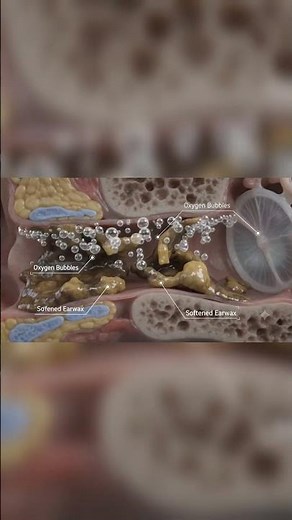 Ear Wax Removal with Ear Drops | How Ear Cleaning Works | 3D Medical Animation #Shorts