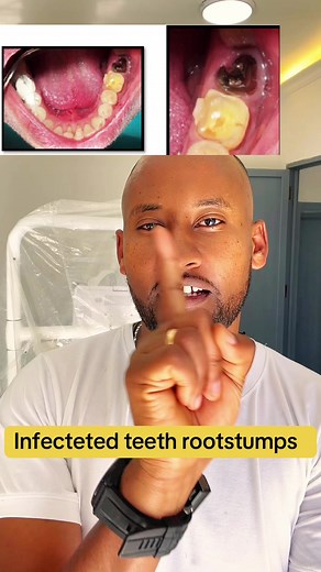 Understanding Infected Teeth Root Stumps and Treatments