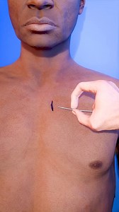 9.3K views · 49 reactions | Un marcapasos es un dispositivo médico...